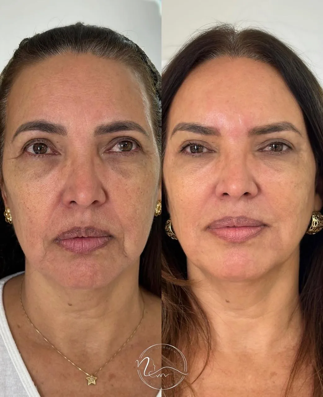 Resultado de tratamento Rejuvenescimento Facial 1
